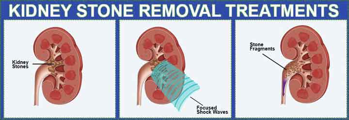 kidney me pathri in hindi